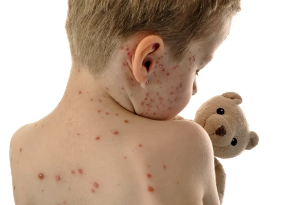 Image for article titled Measles Outbreak